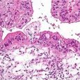 ovarian-cancer-cell