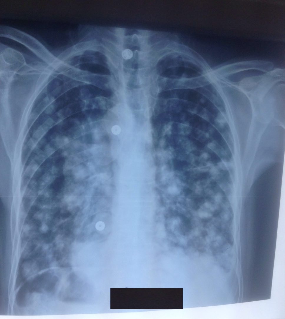Pulmonary tuberculosis coexist with lung cancer: case report – American